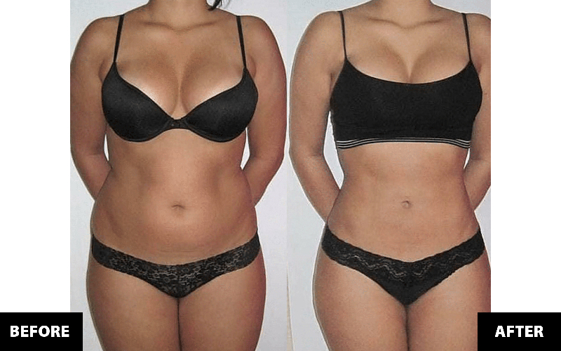 Triba Clinic / Dr. Triba D.C. - Zerona Fat Reduction Treatments