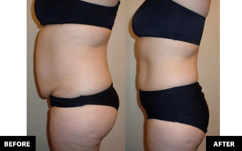 Triba Clinic / Dr. Triba D.C. - Zerona Fat Reduction Treatments