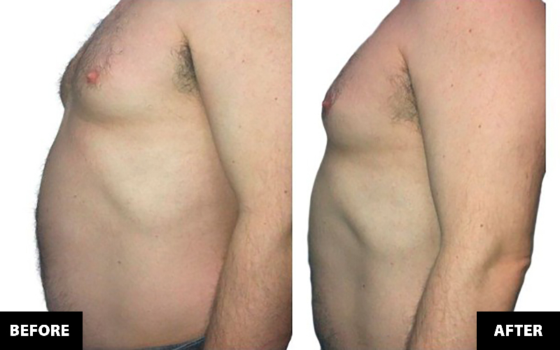 Triba Clinic / Dr. Triba D.C. - Zerona Fat Reduction Treatments
